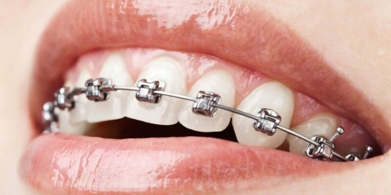 5 Reasons Why Metal Braces Are a Thing of the Past