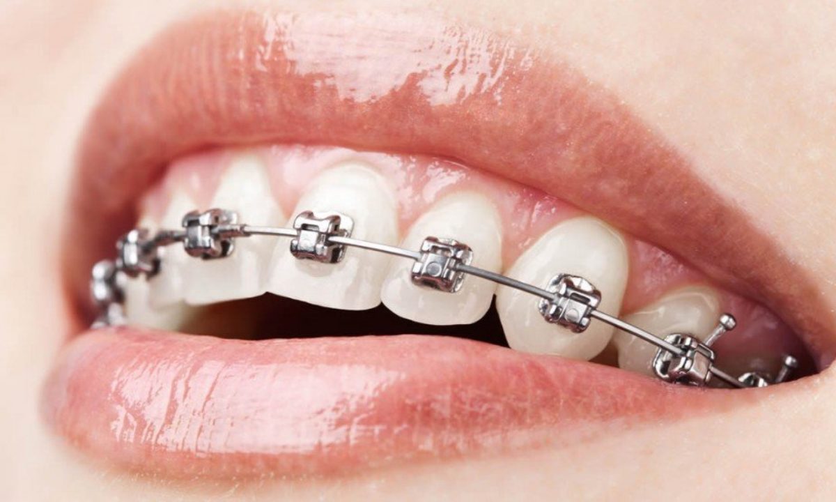 5 Reasons Why Metal Braces Are a Thing of the Past